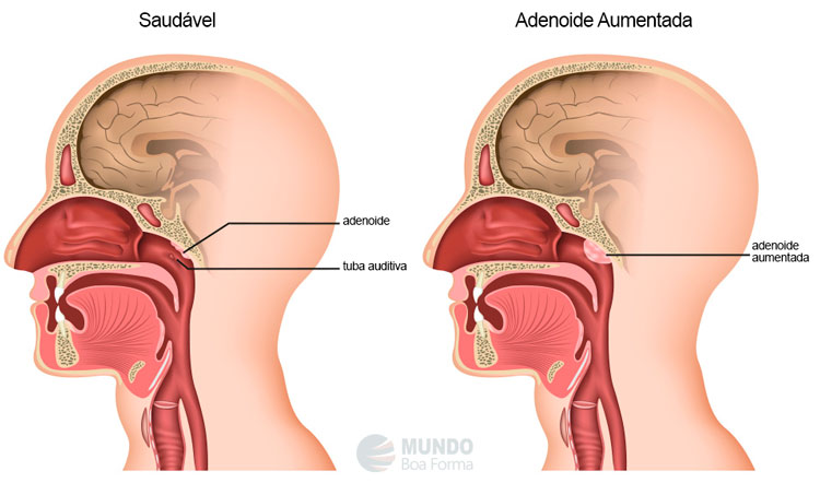 adenoide aumentada vs adenoide normal