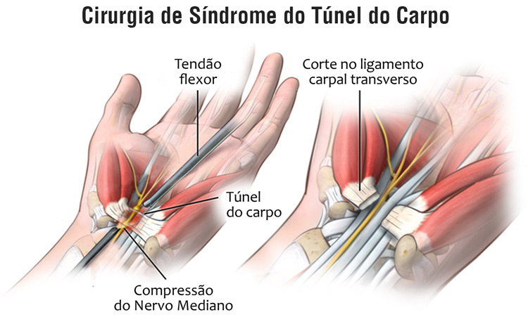 cirurgia de síndrome do túnel do carpo