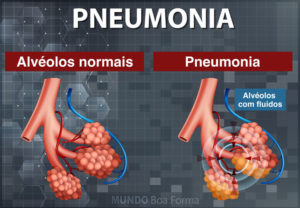 Pneumonia viral: causas, sintomas, tratamento e como prevenir ...
