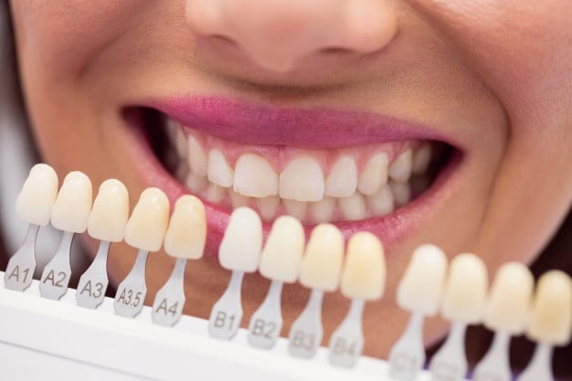 clareamento dental medindo cores