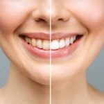 Clareamento dental faz mal para os dentes?