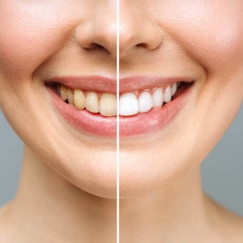 mulher antes e depois do clareamento dental