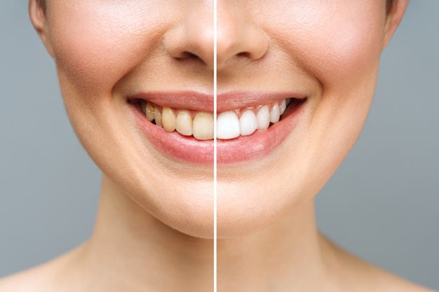 mulher antes e depois do clareamento dental