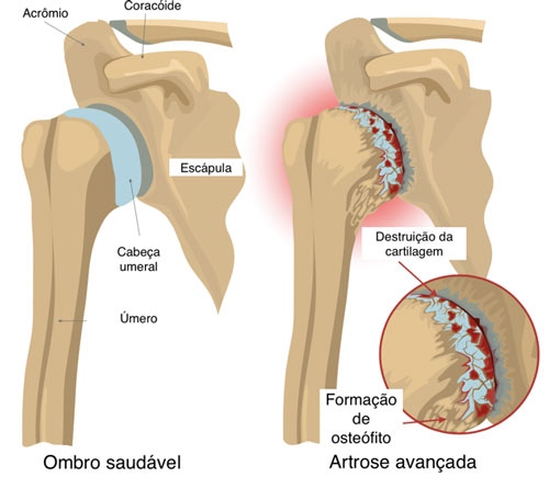 artrose no ombro