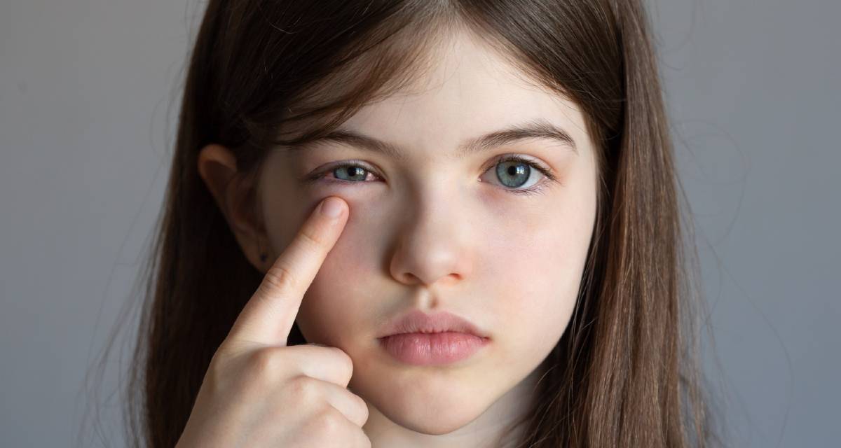 Quanto tempo dura a conjuntivite viral, bacteriana e alérgica? - MundoBoaForma Quanto tempo dura a conjuntivite viral, bacteriana e alérgica? - MundoBoaForma