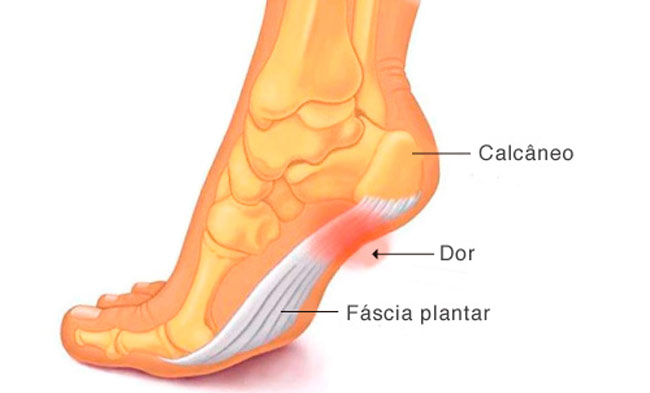 fascite plantar