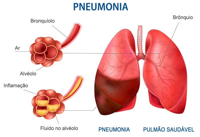 pulmão com pneumonia