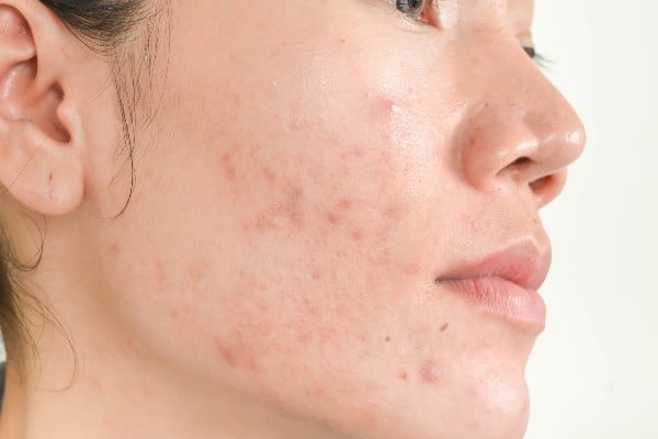Tipos de acne - O que causa espinhas