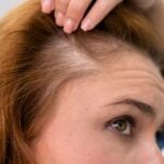 Alopecia feminina: sinais, tipos, como tratar e prevenir