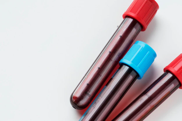 Exame de sangue detecta se o bife de fígado engorda