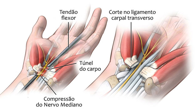 síndrome túnel do carpo ilustração