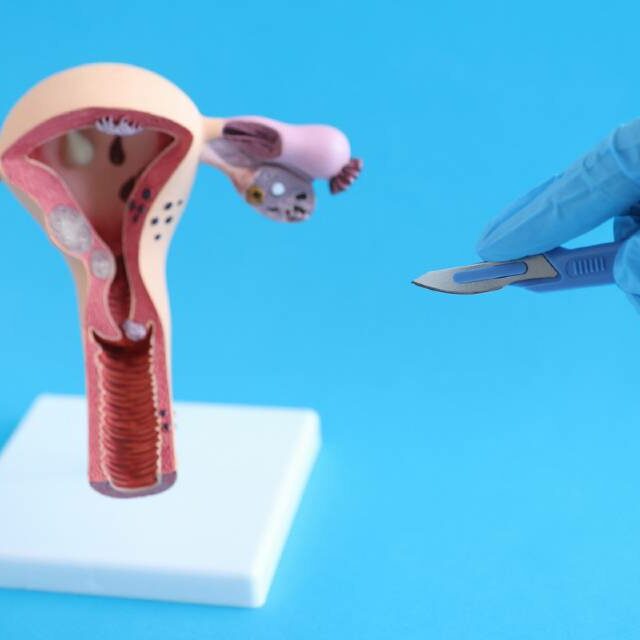 Como é a cirurgia para retirada de cisto no ovário? - MundoBoaForma