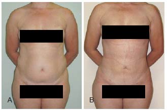 lipo a laser antes e depois