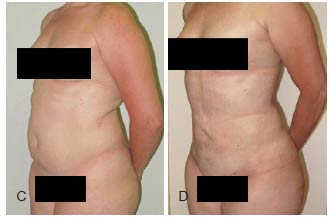 lipo a laser antes e depois