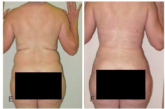 lipo a laser antes e depois