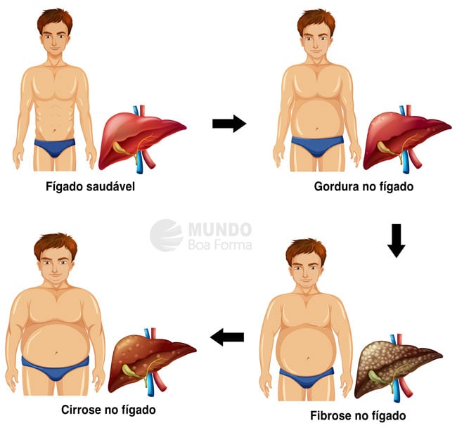 estágios da doença no fígado