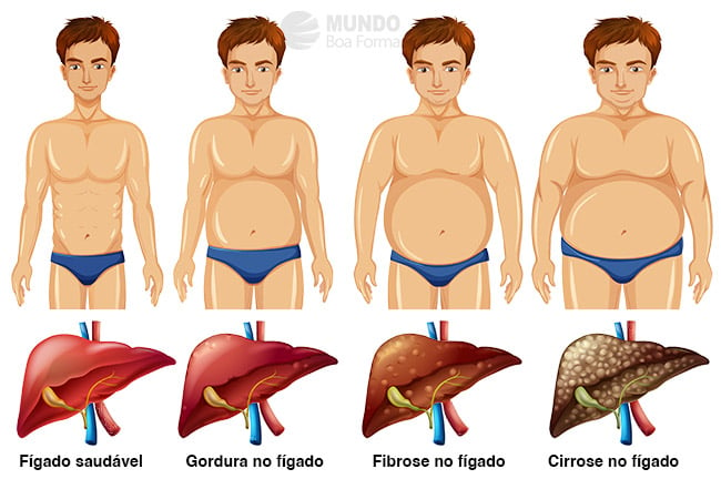 estágios da doença no fígado