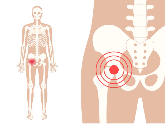 Osteonecrose