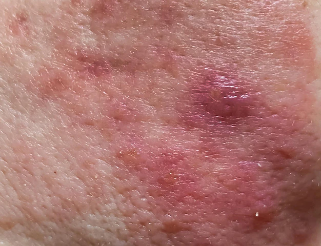 Acne rosácea