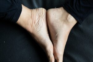 Pé descascando: o que pode ser e como tratar - MundoBoaForma