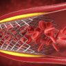 Angioplastia com stent