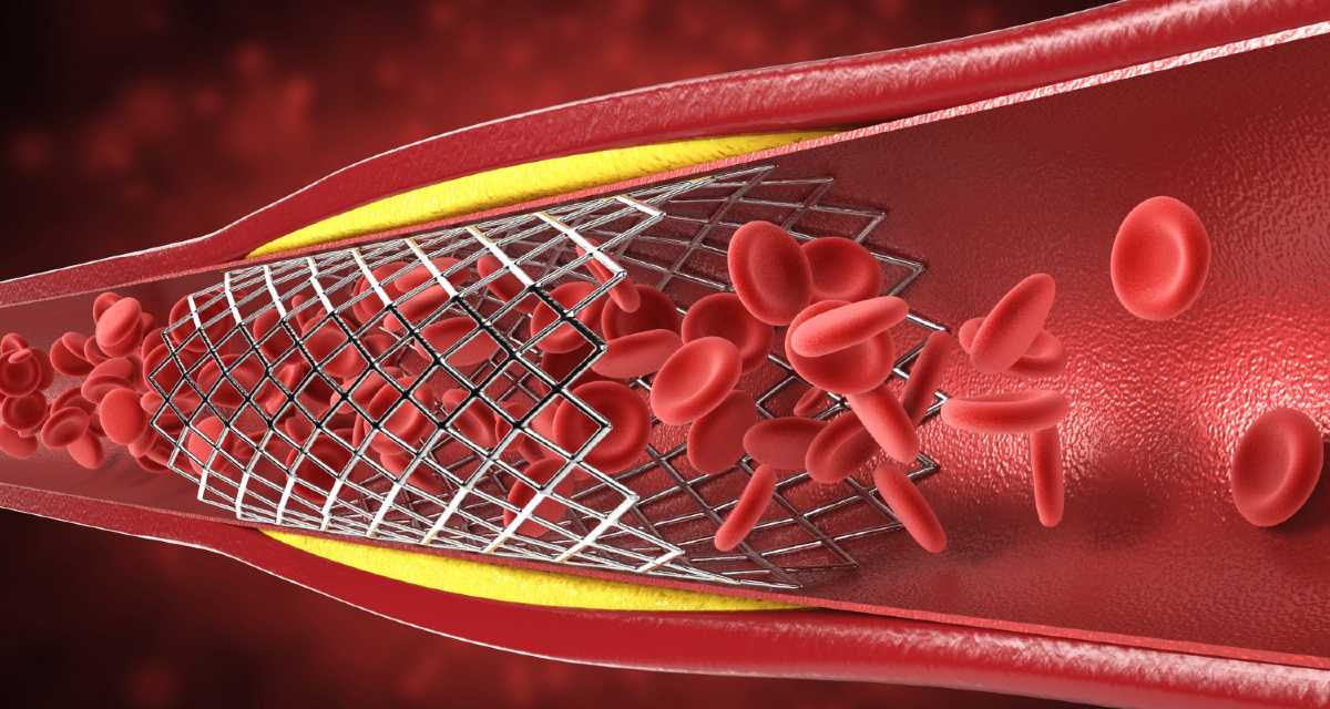 Angioplastia com stent: o que é, para que serve, como é feita e riscos ...