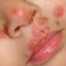 impetigo