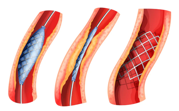 Angioplastia com stent