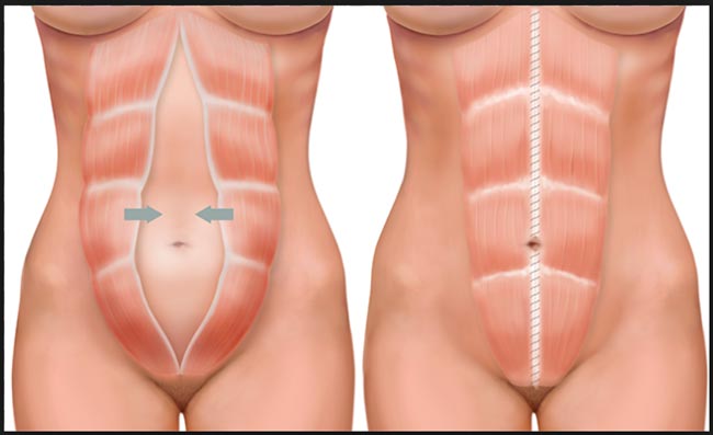 cirurgia de diástase abdominal