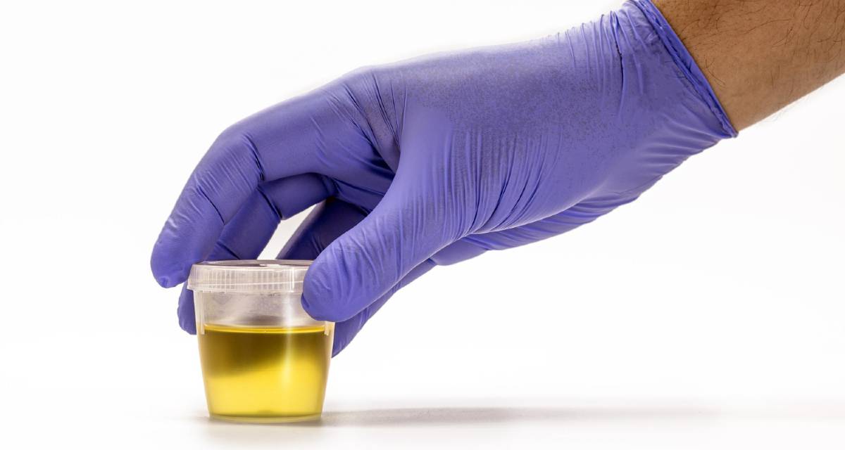 Nelle Urine Si Vede Se Fumi Filamentos De Muco Na Urina O Que Significa