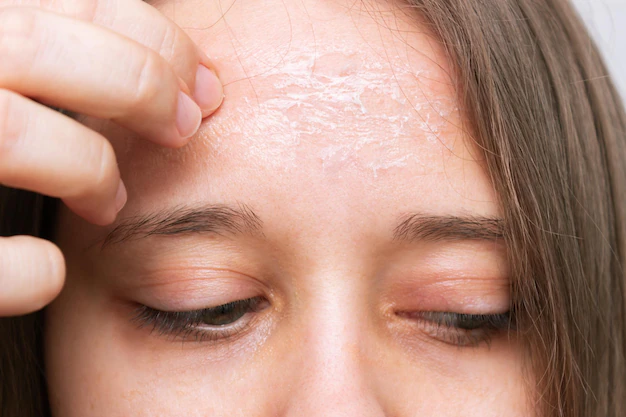 Dermatite no rosto
