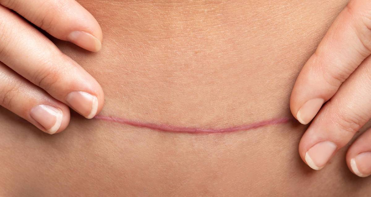 Cicatriz hipertrófica o que é, como se forma, como evitar e tratar