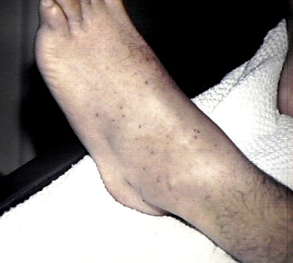 Petechiae