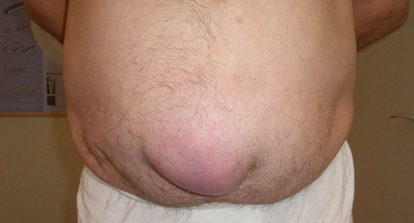 Hernia umbilical