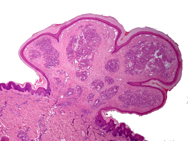 Granuloma