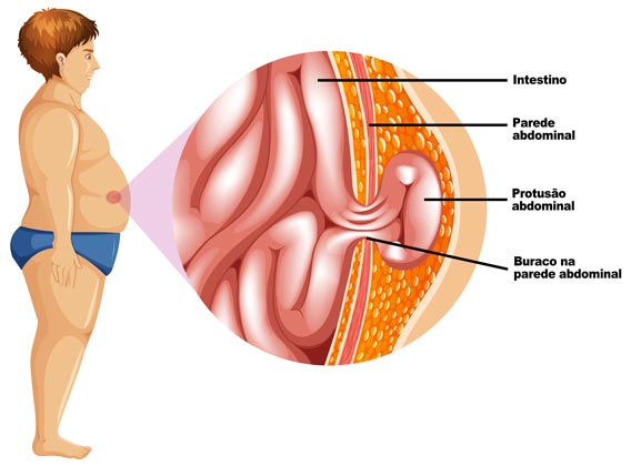 hérnia abdominal