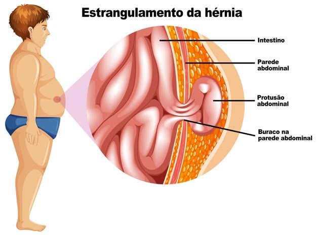 hérnia abdominal