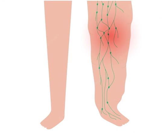 linfedema