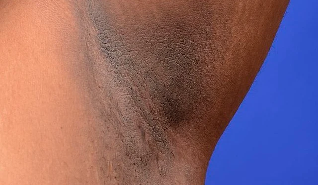 Acanthosis nigricans