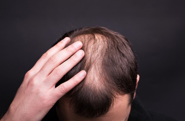 Close-up da cabeça masculina com calcície com fundo preto em estúdio