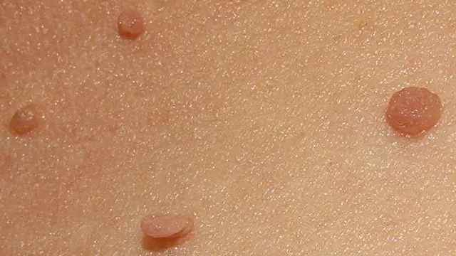 Fibroma mole