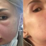 Cartier Bugatti remoção do preenchimento labial