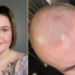 Shauna Higgins antes e depois do procedimento.