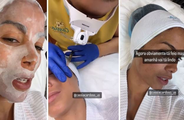 Anitta faz procedimento com sangue no rosto. 