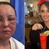Beatrice Gaucahas, com lesões na pele devido aos efeitos do eczema e ela com a pele normal