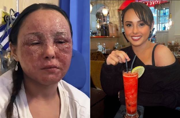 Beatrice Gaucahas, com lesões na pele devido aos efeitos do eczema e ela com a pele normal