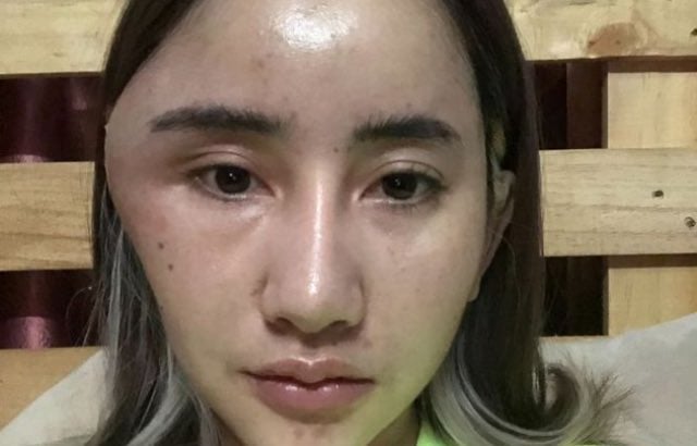Dj Nouna com o rosto desfigurado, post Instagram 