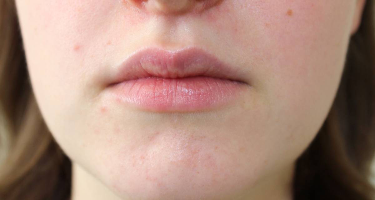 Dermatite perioral