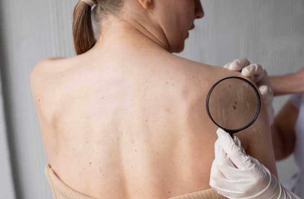 Médico examinando paciente com suspeita de melanoma acral 