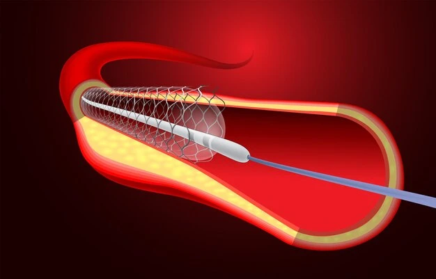 Angioplastia